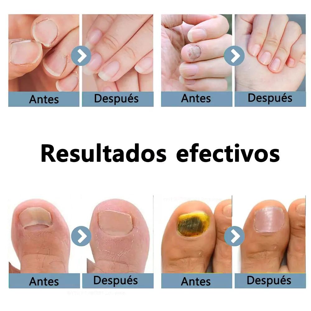 Dispositivo laser LED para uñas