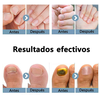 Dispositivo laser LED para uñas